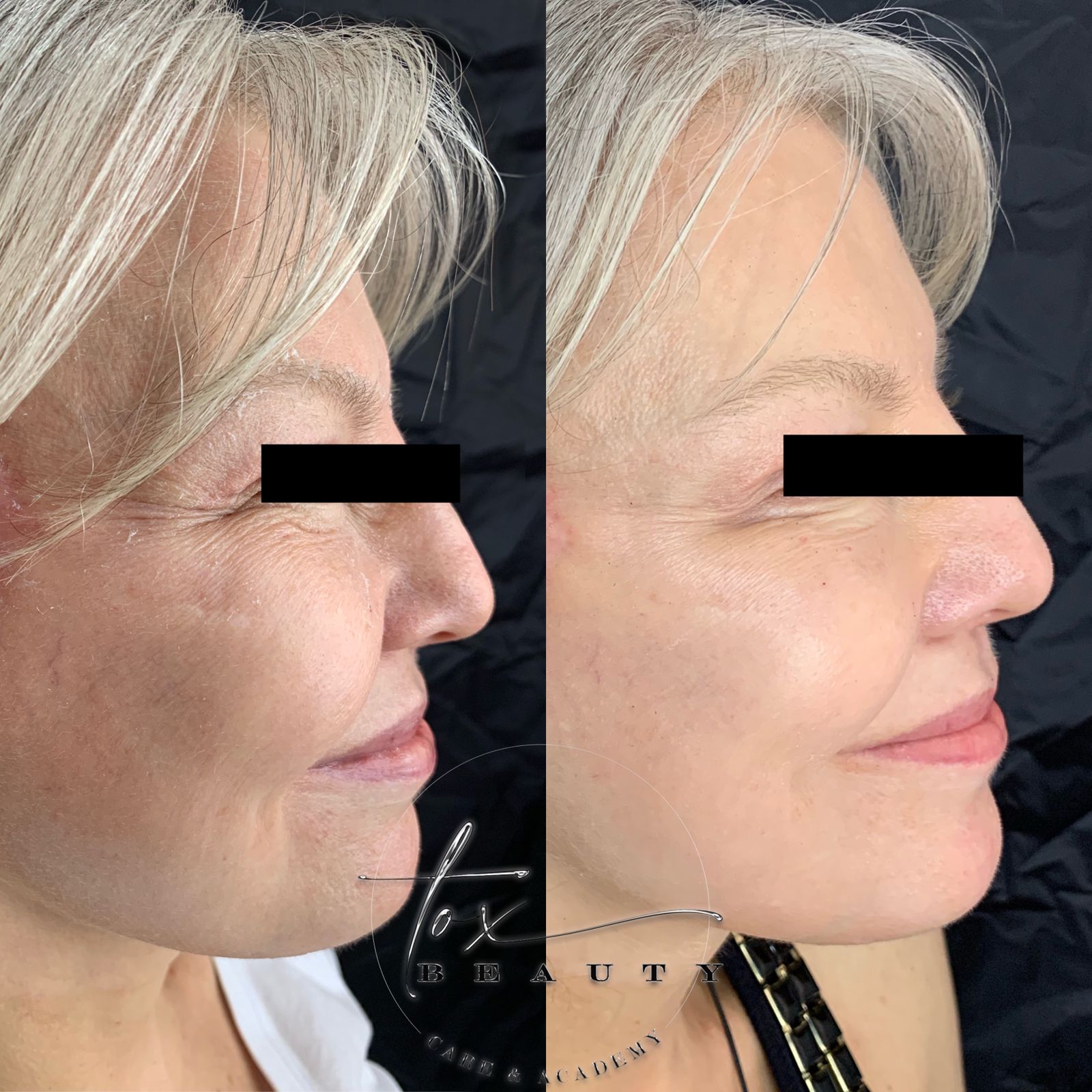 Preenchimento Labial OU Botox + Extensão de Cílios